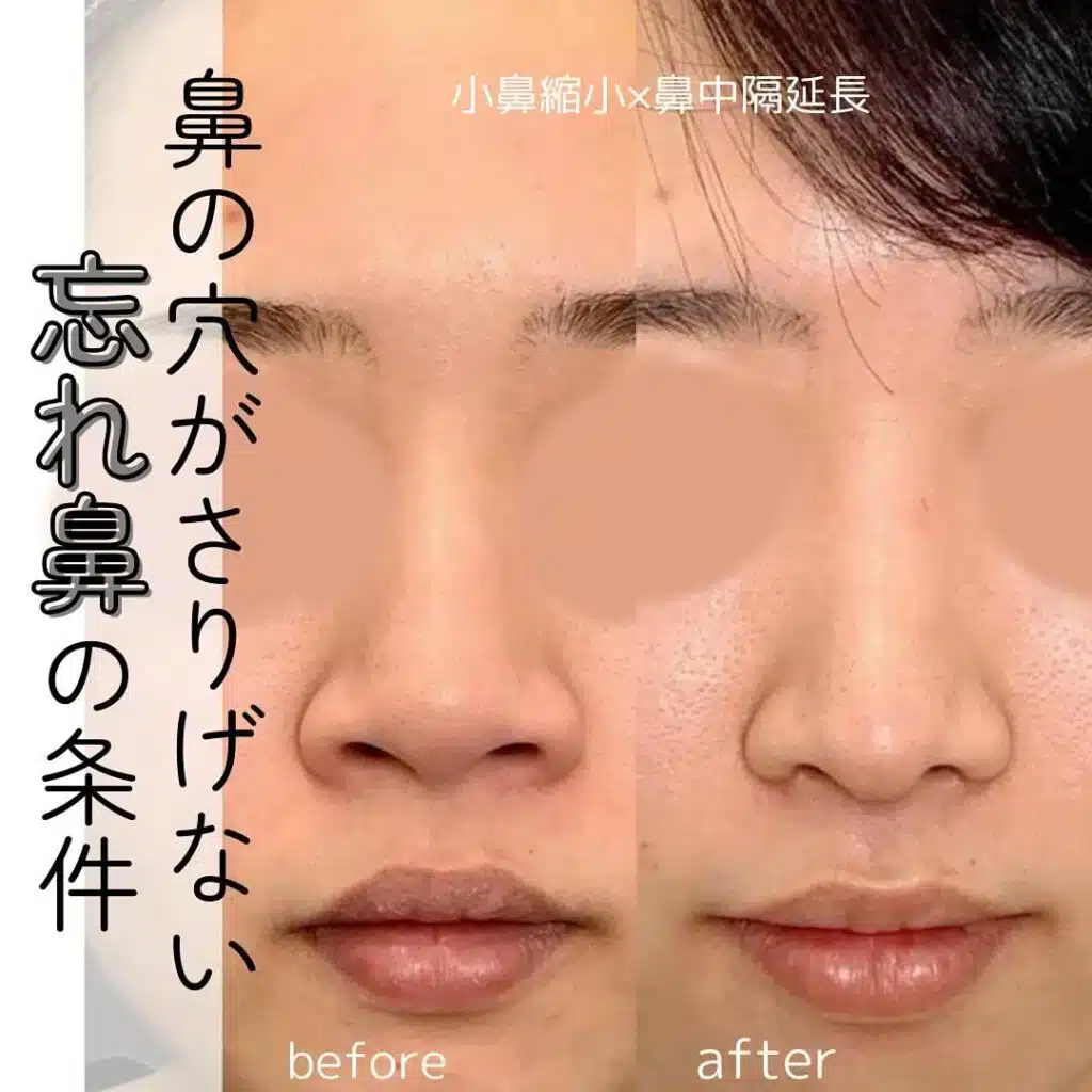 小鼻縮小×鼻中隔延長 新宿