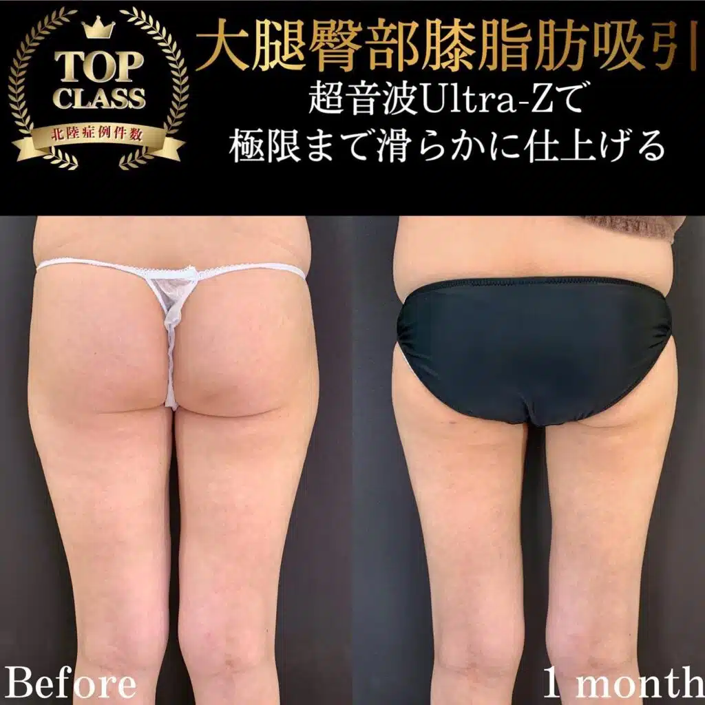 大腿臀部膝脂肪吸引 新宿