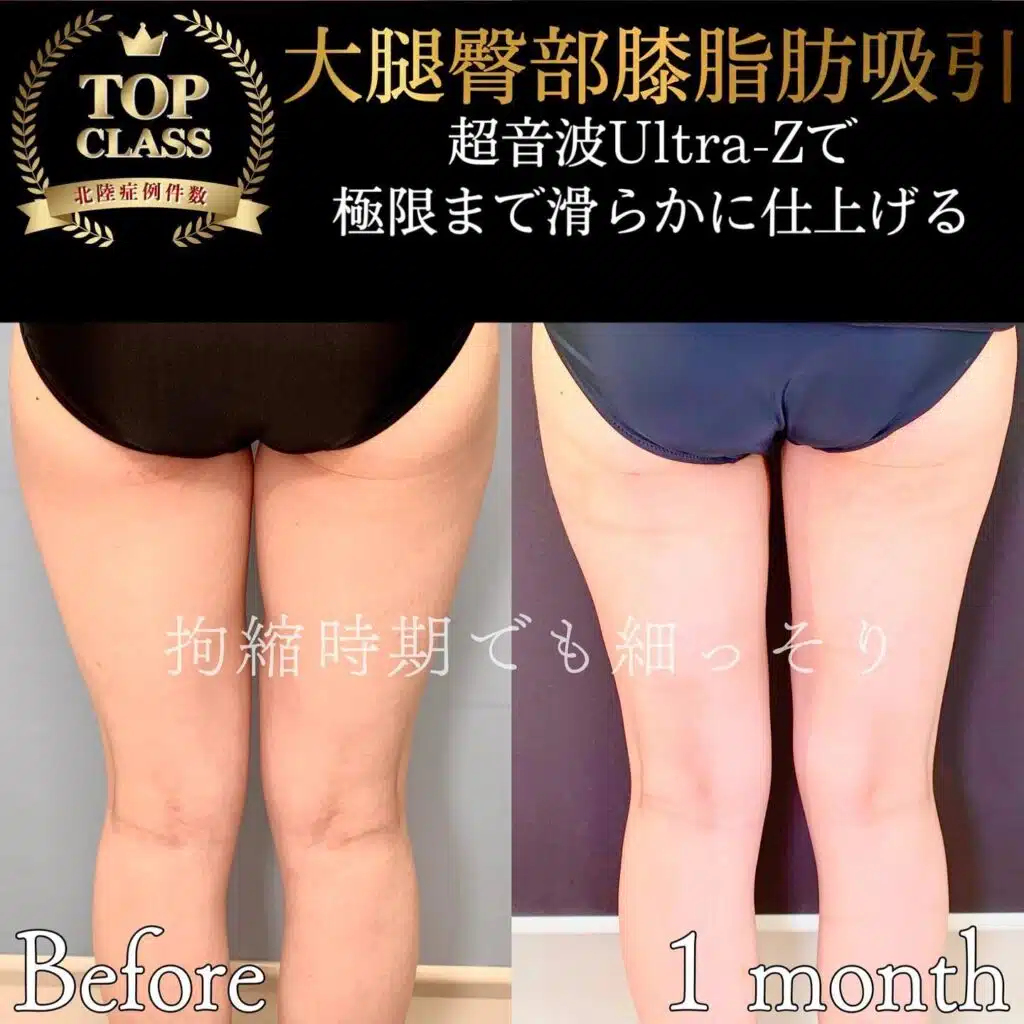 大腿臀部膝脂肪吸引 新宿