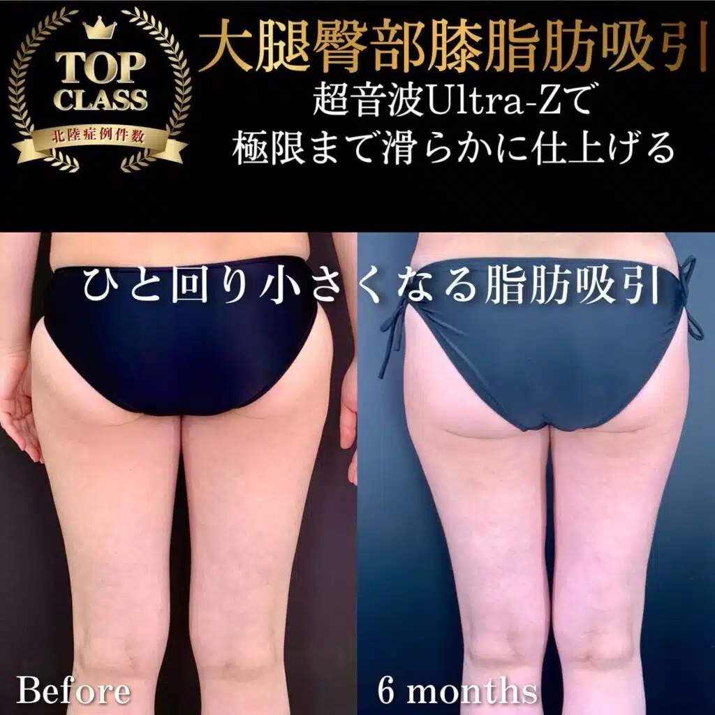 大腿臀部膝脂肪吸引 新宿