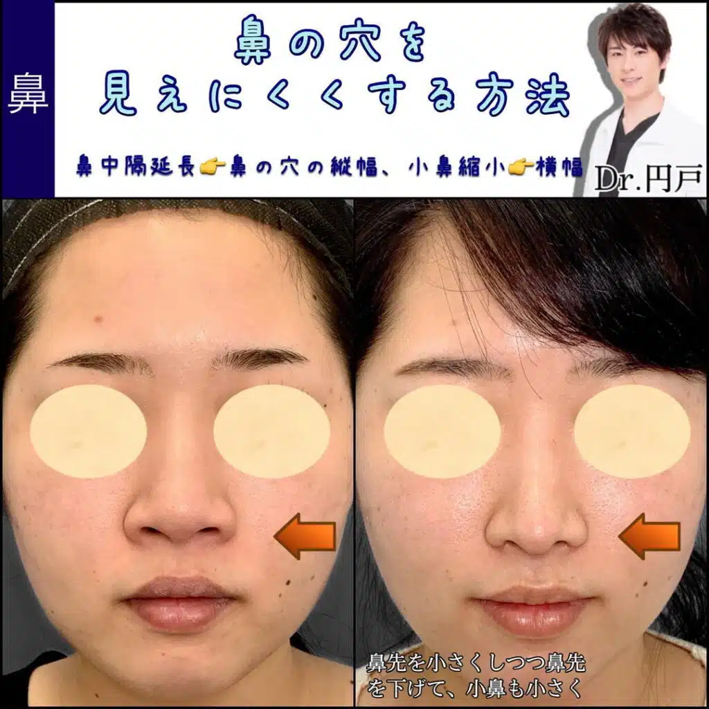 鼻中隔延長 小鼻縮小 新宿