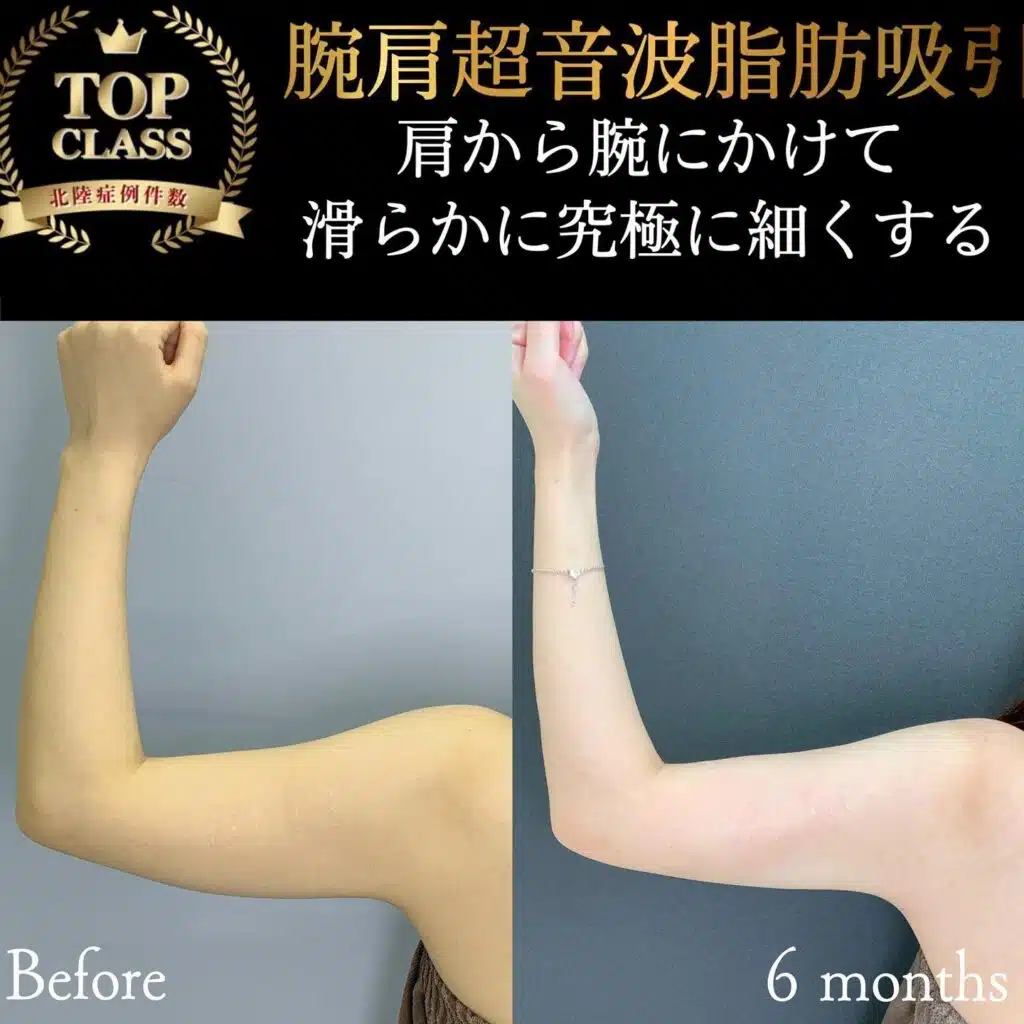 腕肩超音波脂肪吸引 新宿