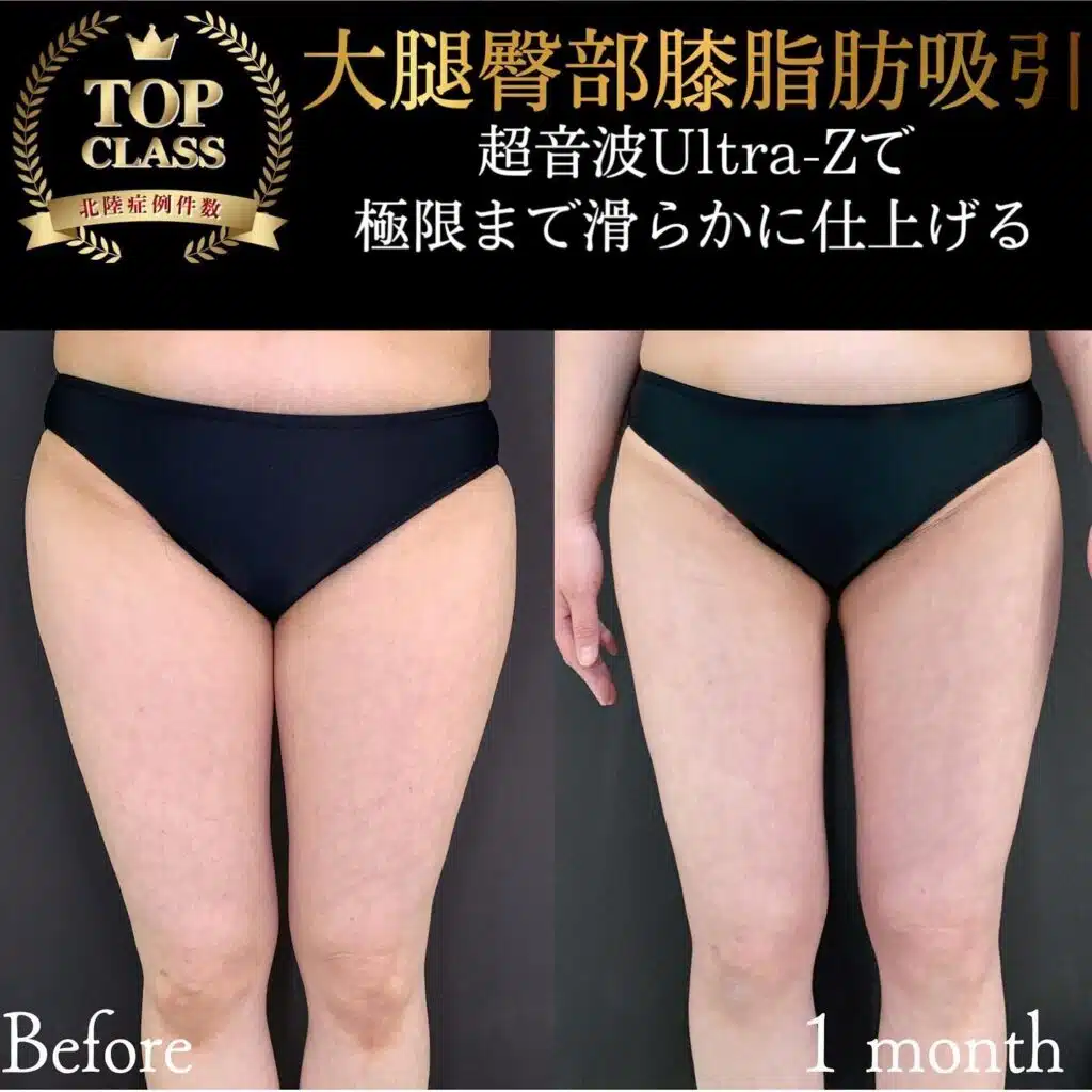 大腿臀部膝脂肪吸引 新宿