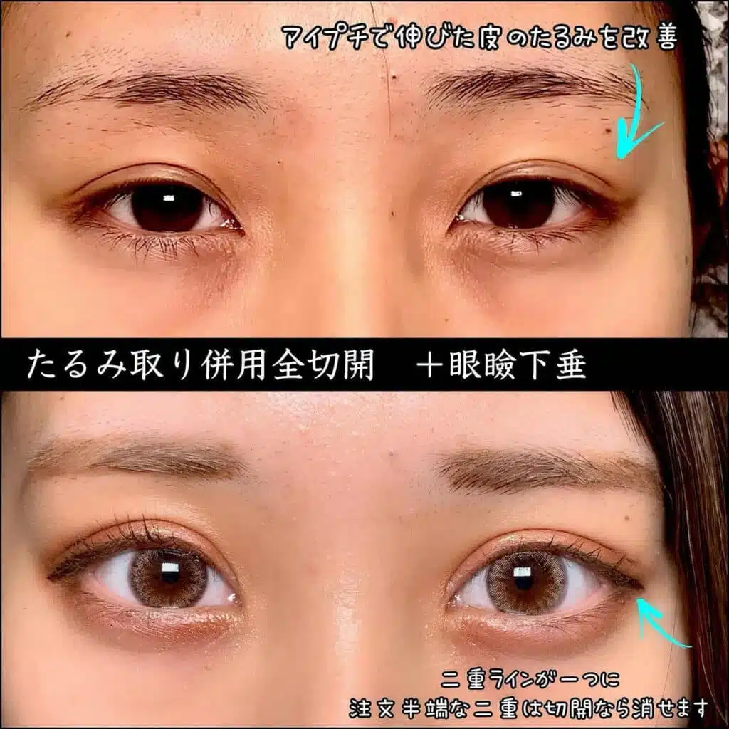 たるみ取り併用全切開+眼瞼下垂　新宿