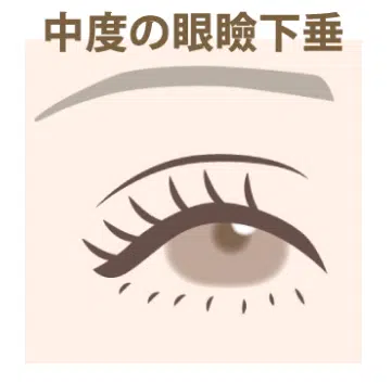 中度の眼瞼下垂　新宿