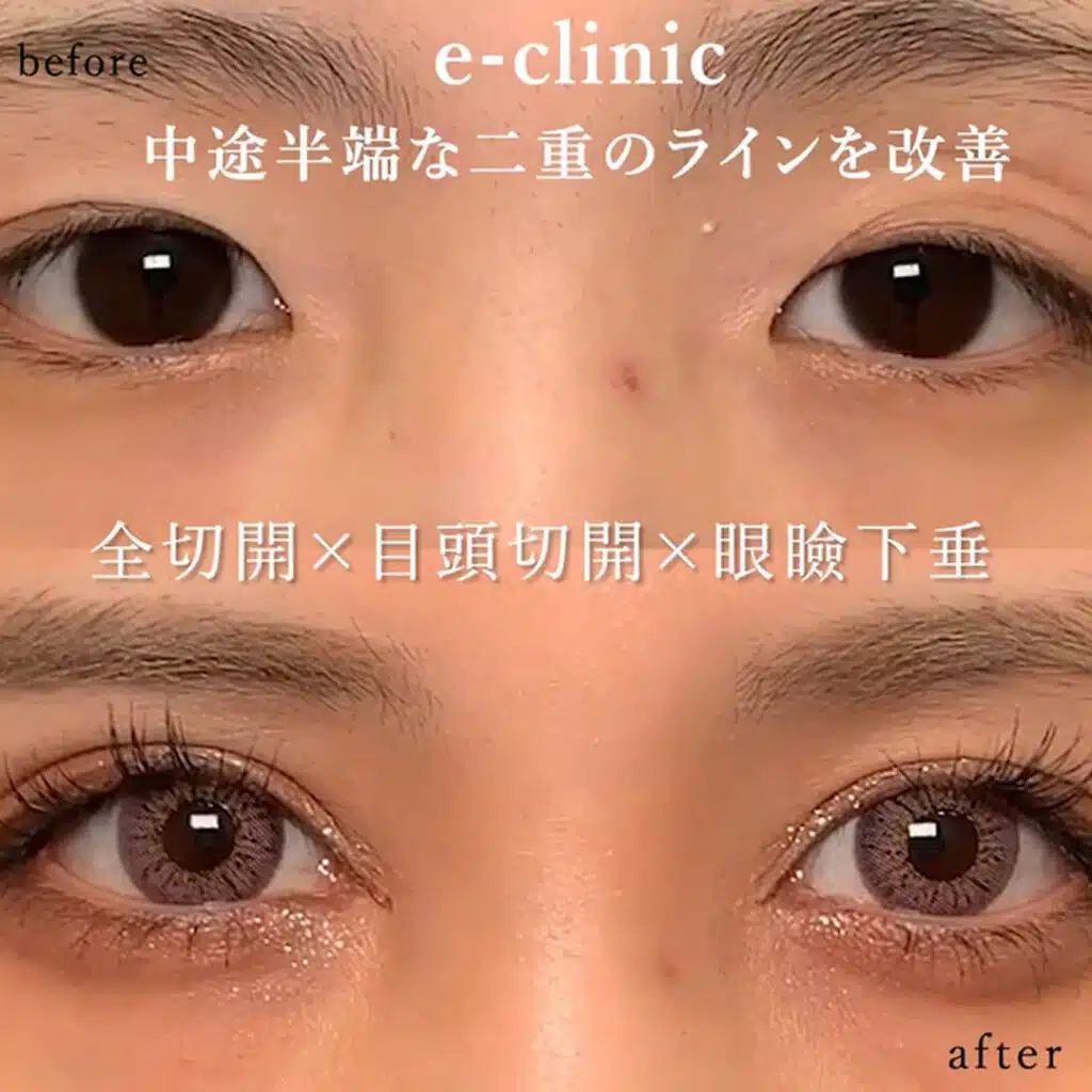 全切開×目頭切開×眼瞼下垂　新宿