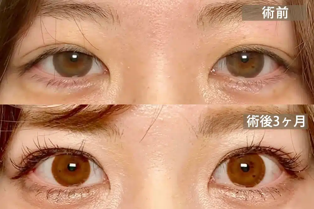 先天性眼瞼下垂　新宿