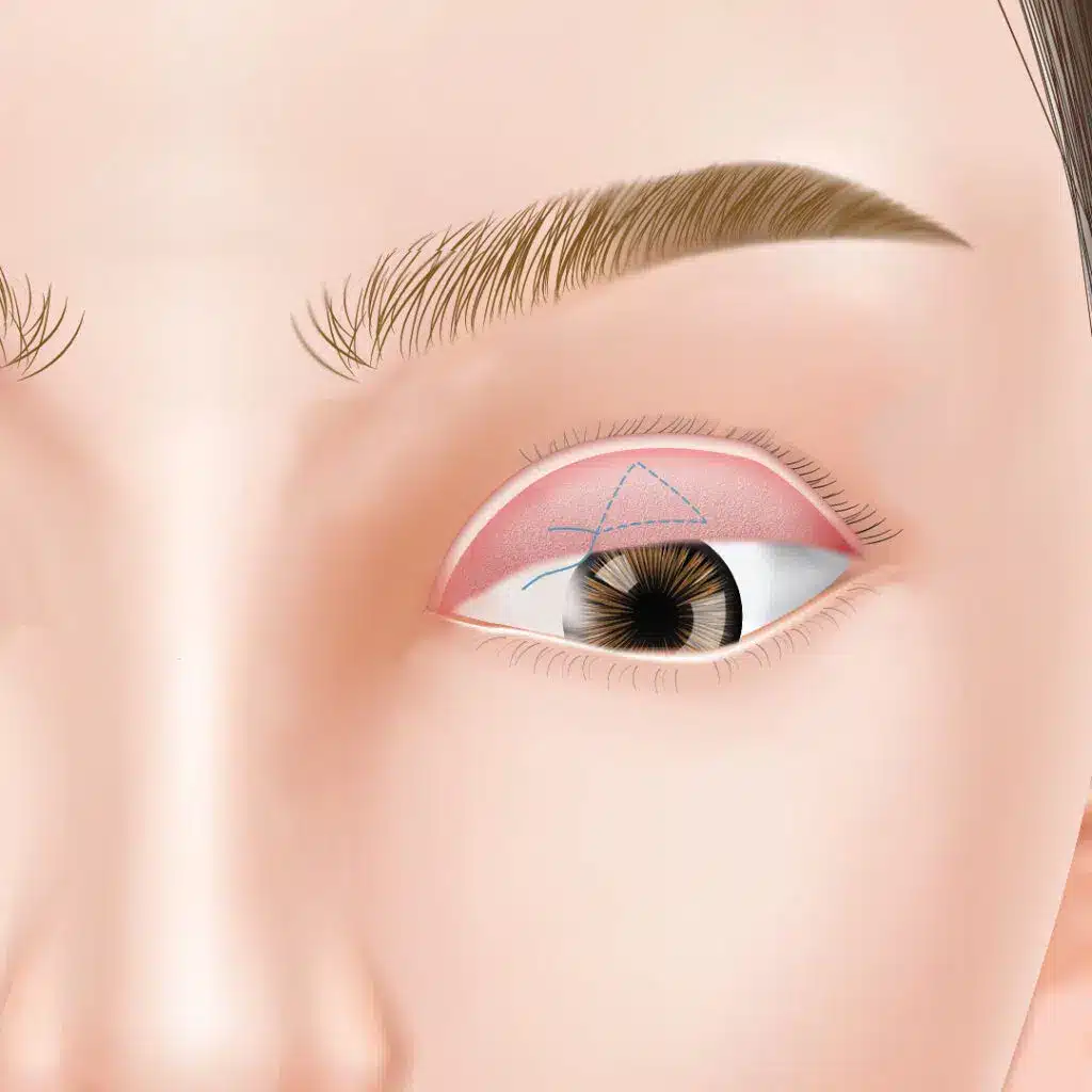 眼瞼下垂　手術方法　新宿