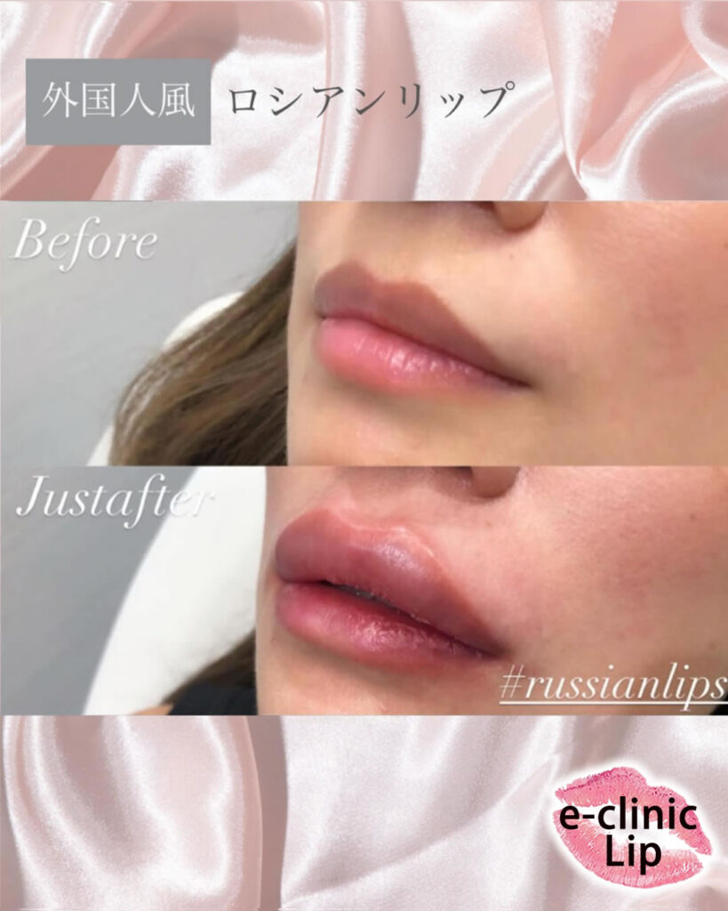 唇のヒアルロン酸の症例写真