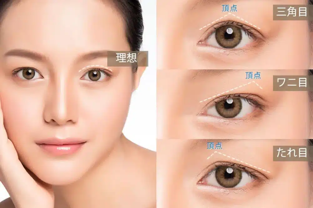 眼瞼下垂の失敗例の説明　新宿