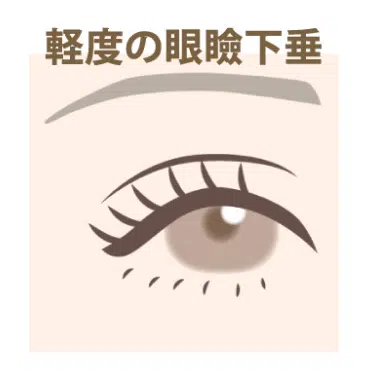 軽度の眼瞼下垂　新宿