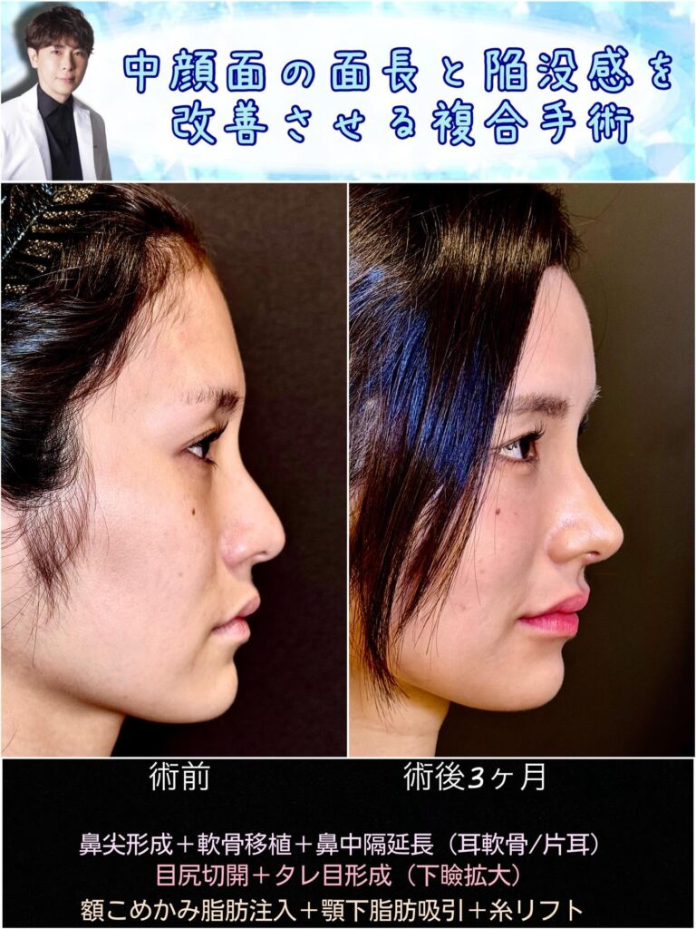 のっぺり顔を改善したのと中顔面陥没を改善した横から見た症例写真