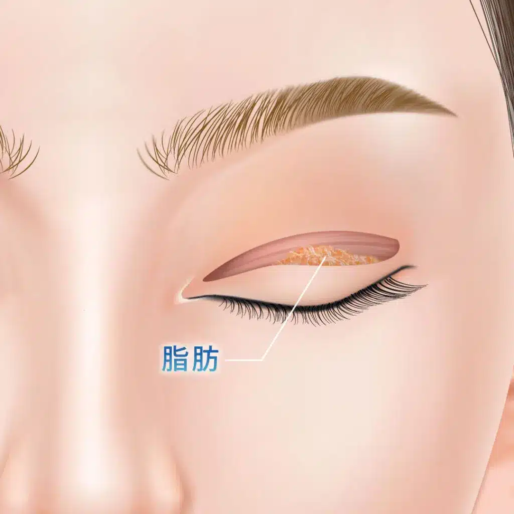 眼瞼下垂　手術方法　新宿
