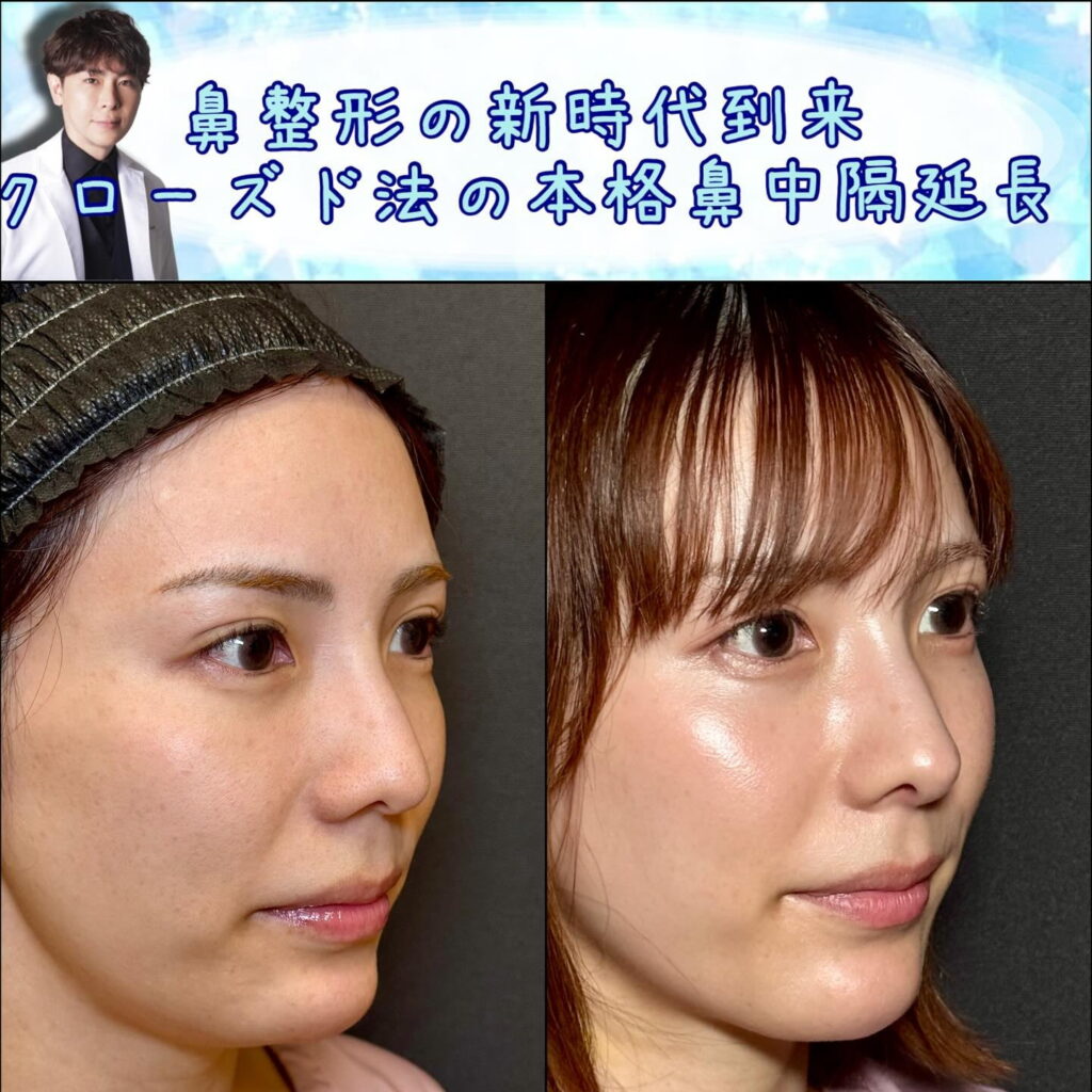 斜めから見たクローズド法の鼻中隔延長の症例写真