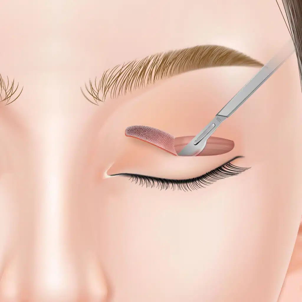 眼瞼下垂　手術方法　新宿