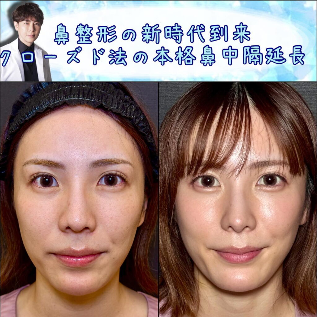 正面から見たクローズド法の鼻中隔延長の症例写真