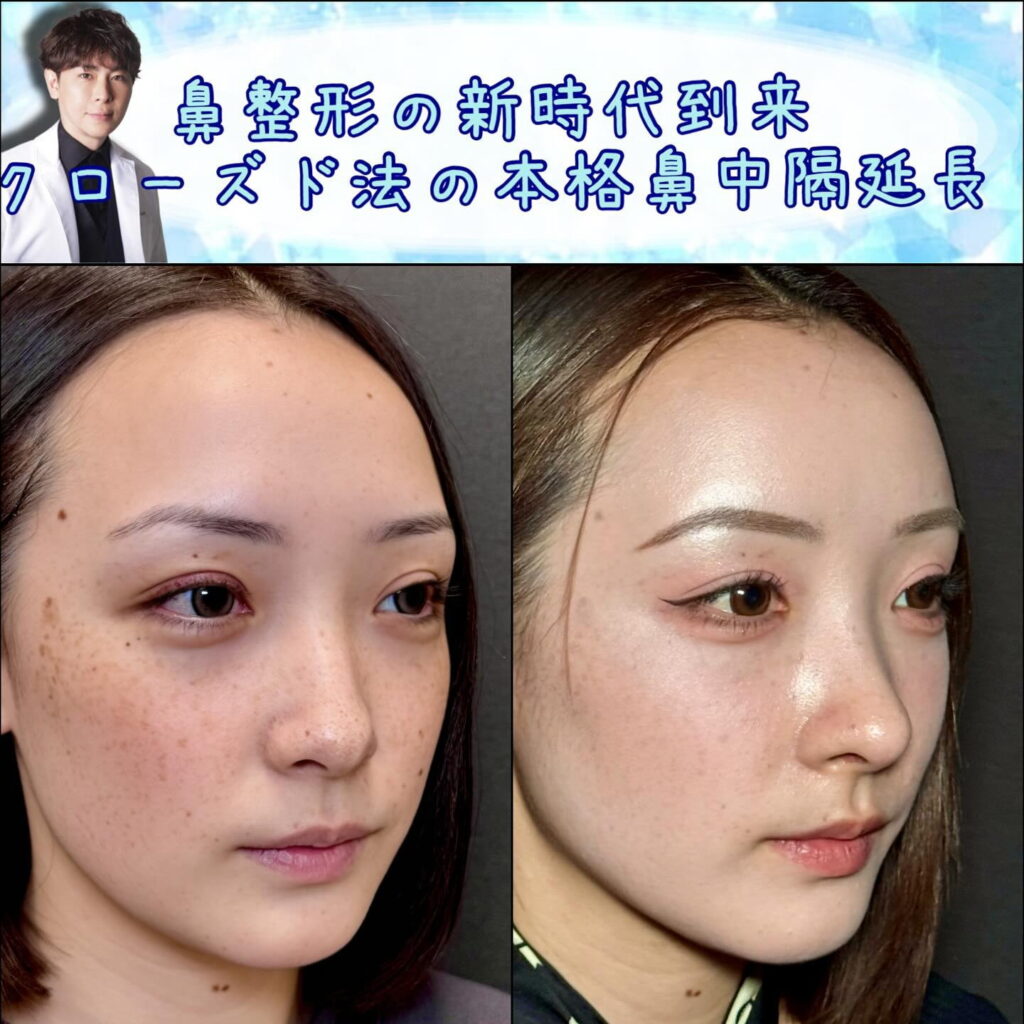 斜めから見た傷がない鼻中隔延長の顔全体の症例写真