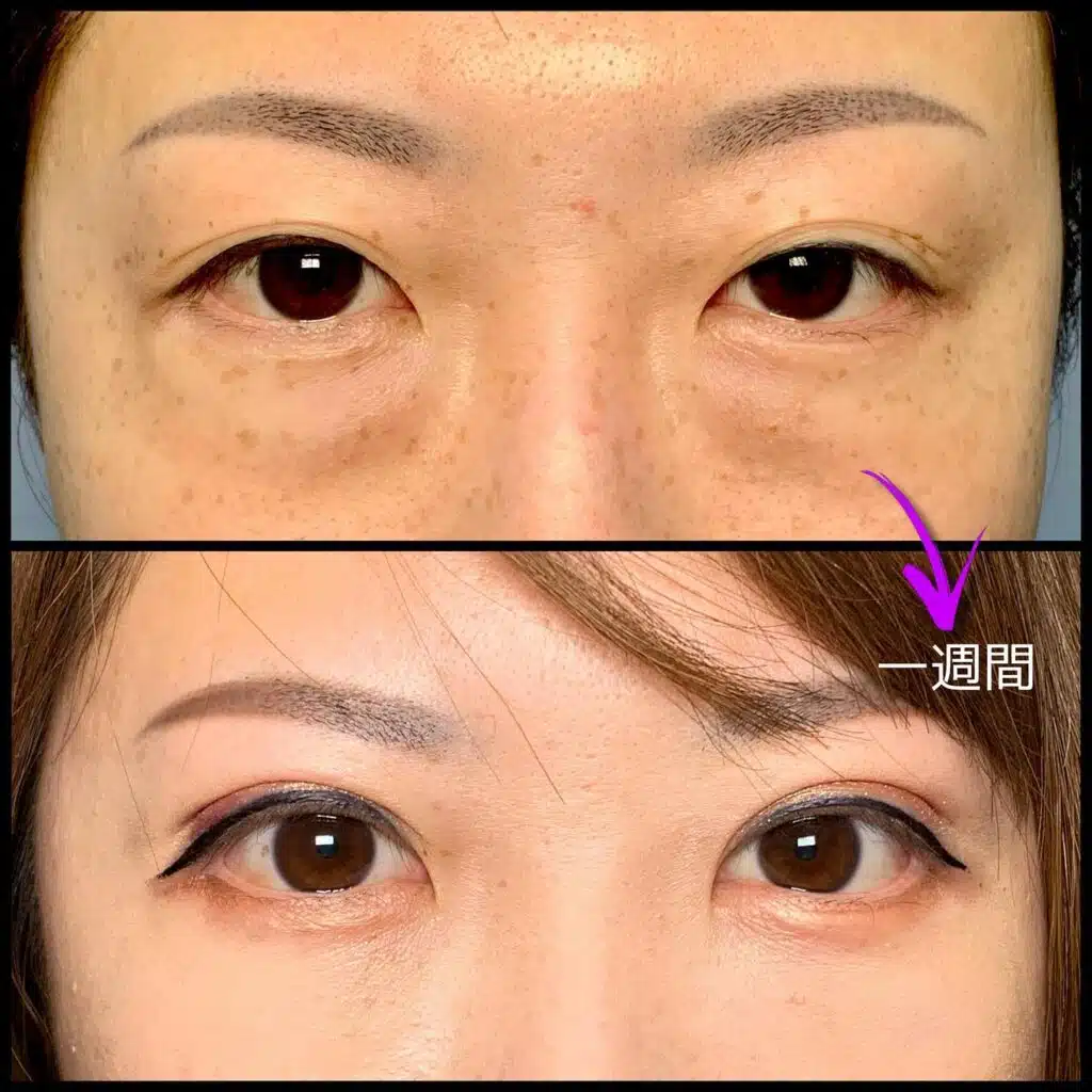 眼瞼下垂と全切開の傷跡の他院修正の１週間後の症例　新宿