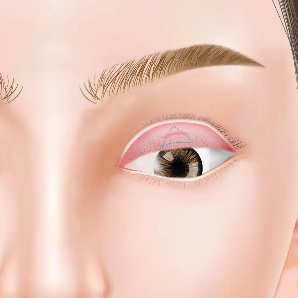 眼瞼下垂　手術方法　新宿