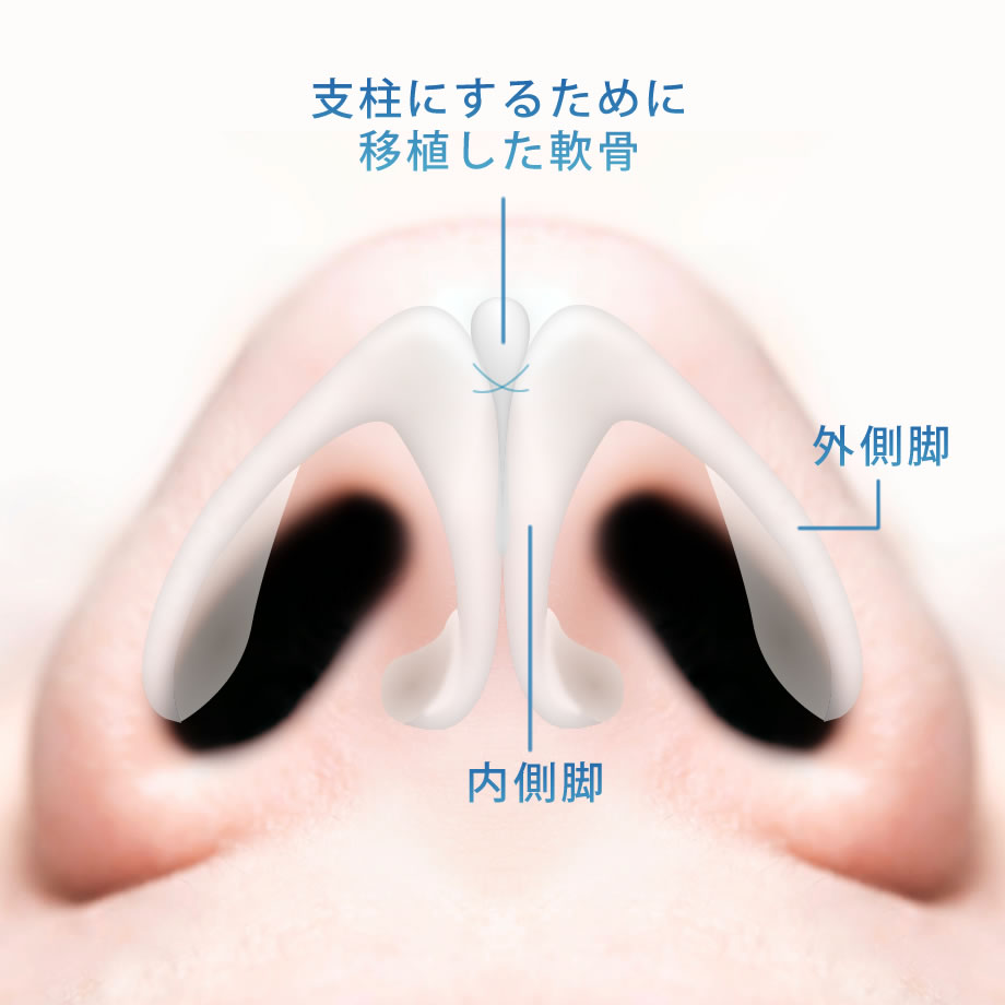 コルメラストラット法（プラスストラット）の図解