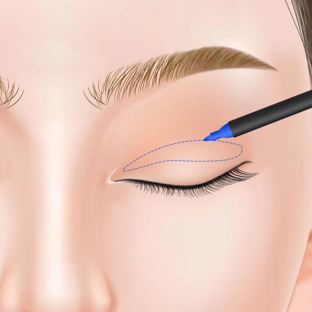 眼瞼下垂　手術方法　新宿