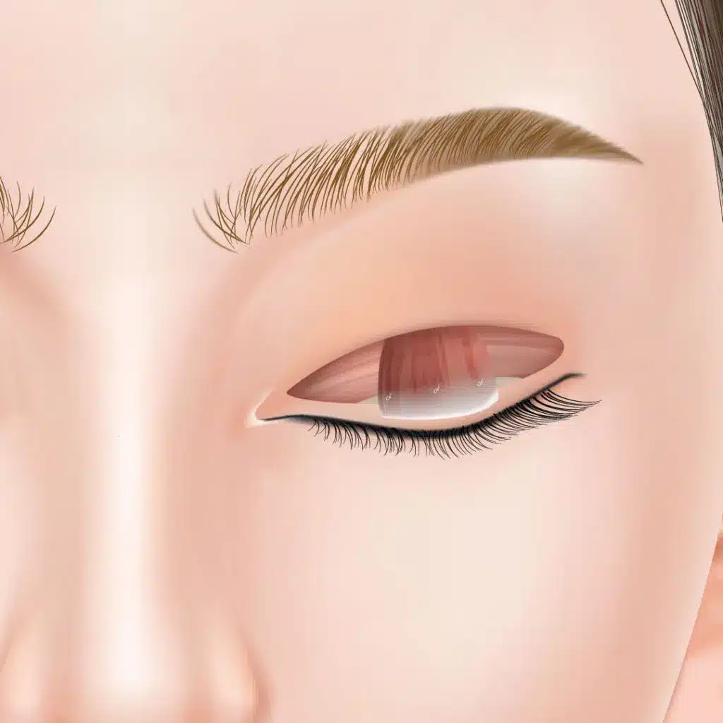 眼瞼下垂　手術方法　新宿