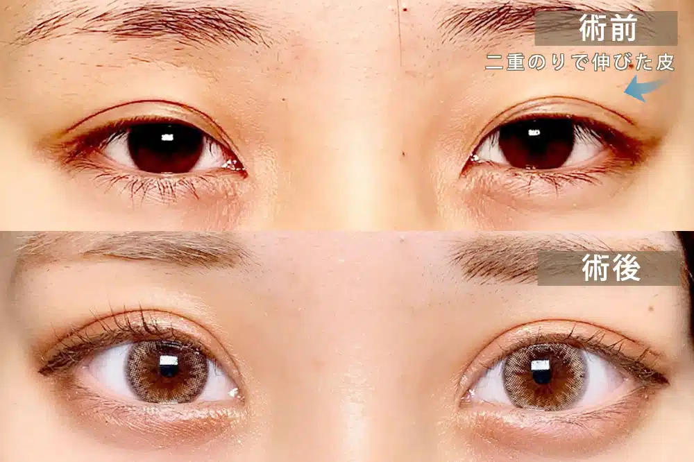 偽眼瞼下垂　新宿