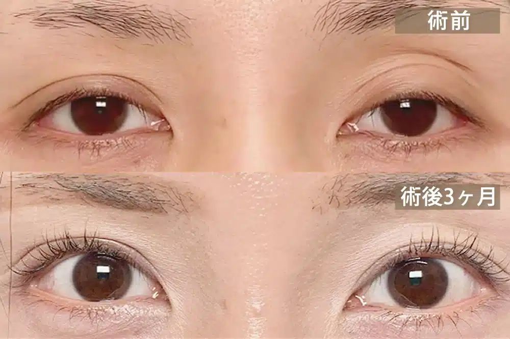 腱膜性眼瞼下垂（後天性眼瞼下垂）　新宿