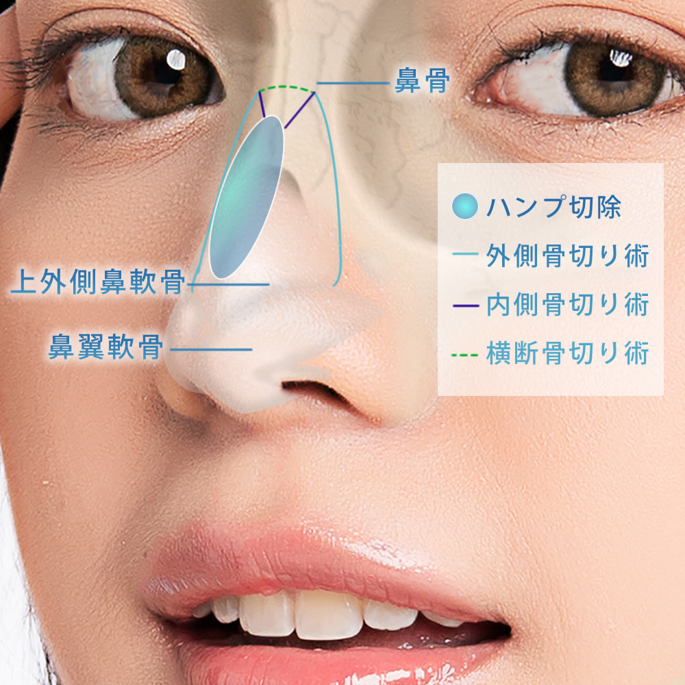 鼻骨骨切りの切開部分の図解