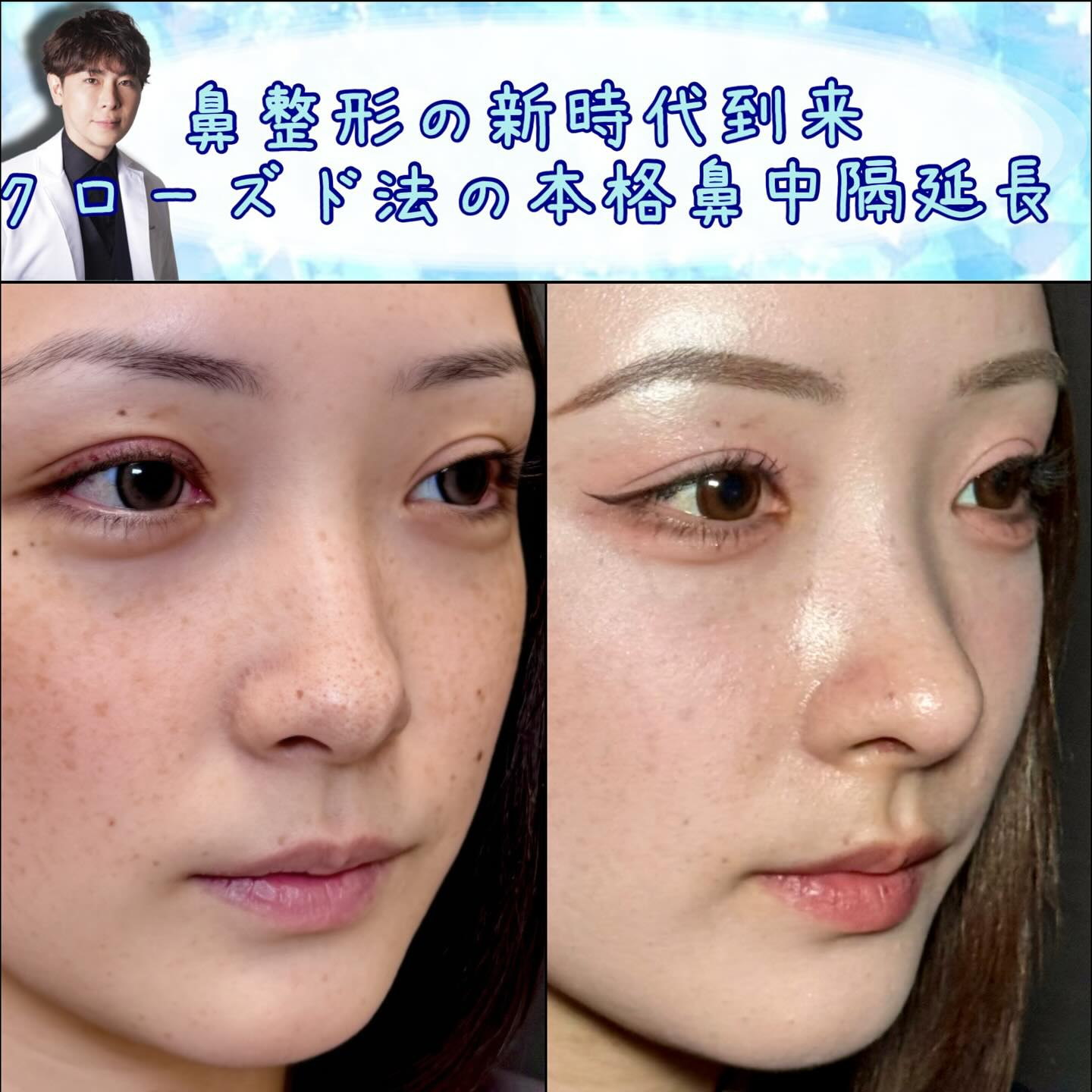 斜めから見た傷がない鼻中隔延長の症例写真