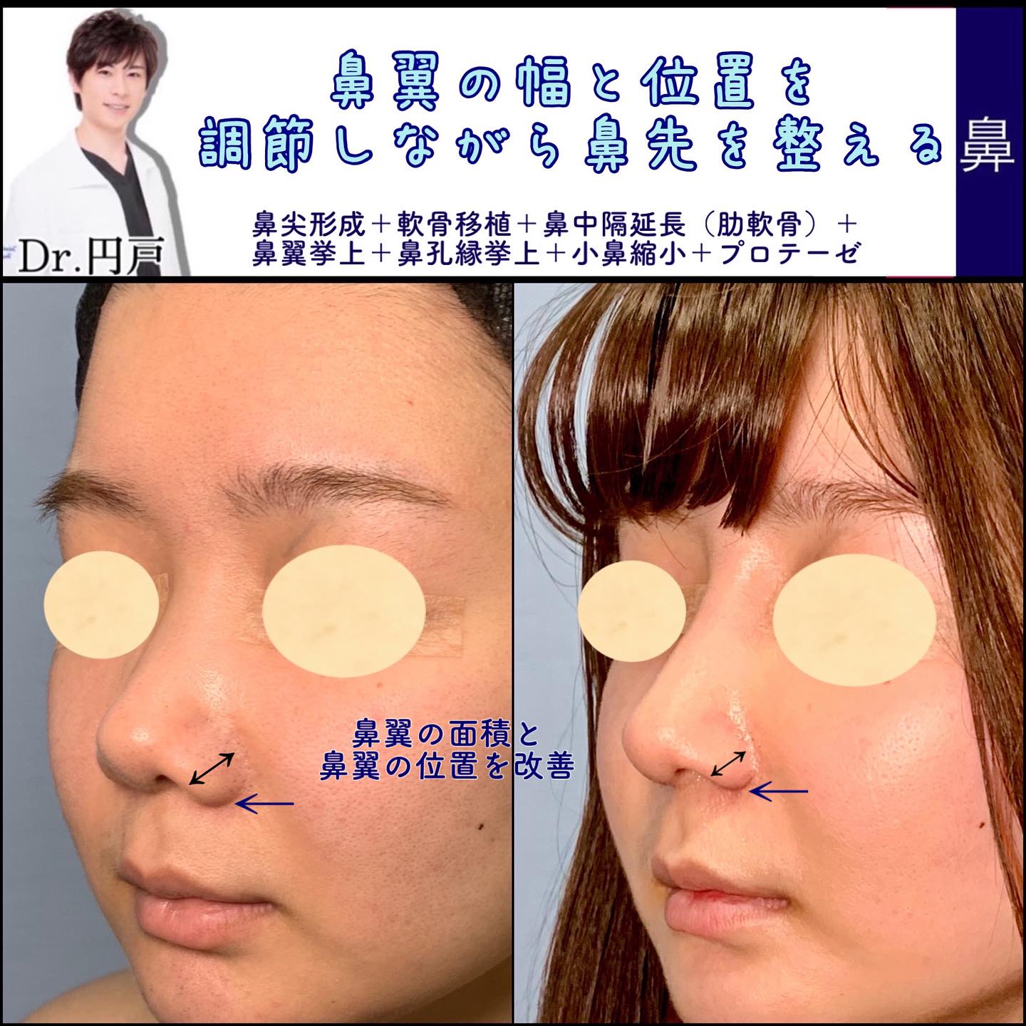 鼻尖形成と軟骨移植と肋軟骨の鼻中隔延長と鼻翼挙上と鼻孔縁挙上と小鼻縮小とプロテーゼを同時に行った症例を斜めから見た写真