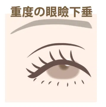 重度の眼瞼下垂　新宿