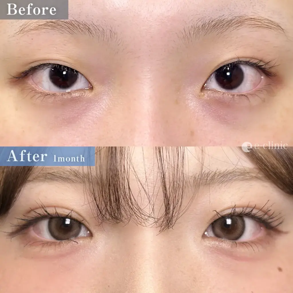 eclinicの二重症例(デザイン)
二重埋没法 自然癒着(名医の劉医師が執刀)