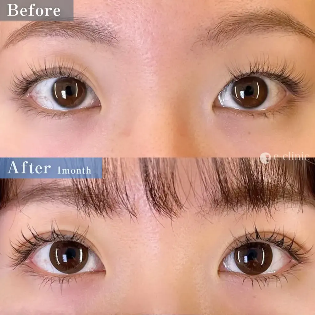 eclinicの二重症例(デザイン)
二重埋没法 クイックループダブル4点裏留め(名医の島田医師が執刀)