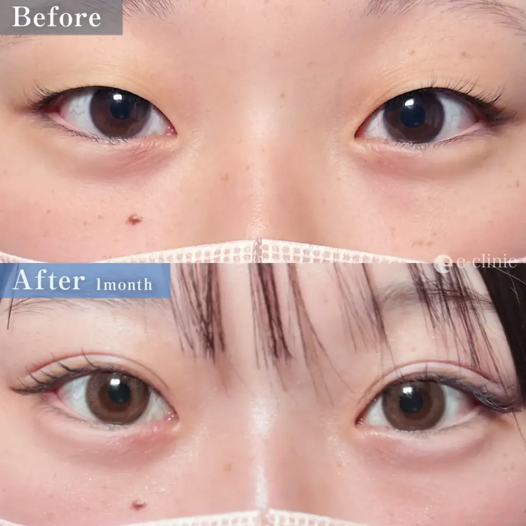 eclinicの二重症例(デザイン)
二重埋没法 自然癒着(名医の伊藤医師が執刀)