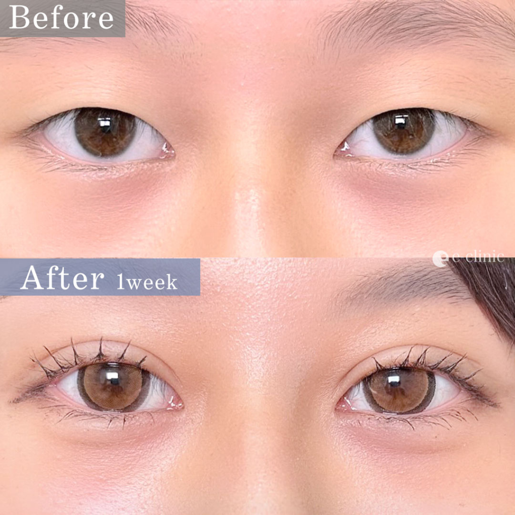 eclinicの二重症例(デザイン)
二重埋没 自然癒着法(名医の相原医師が執刀)