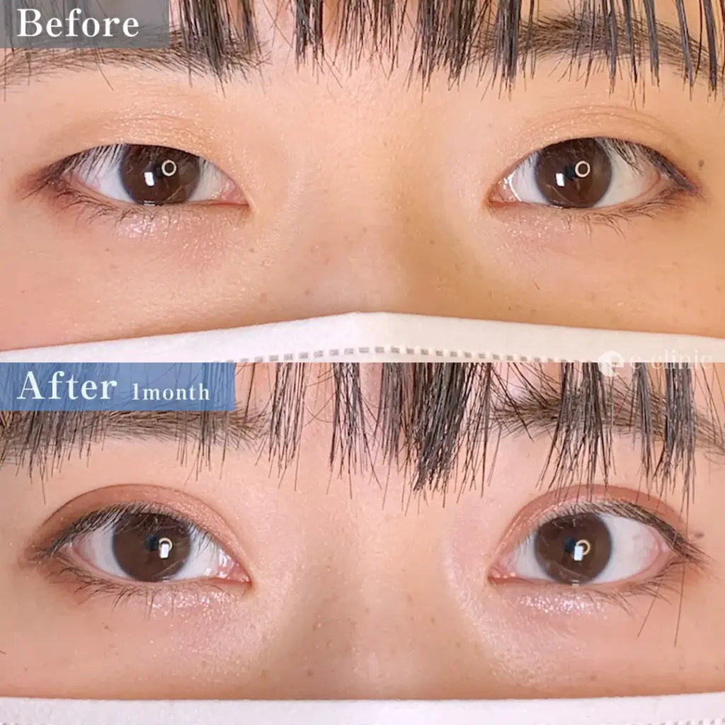 eclinicの二重症例(デザイン)
二重埋没法 特殊6点留め(名医の張田医師が執刀)