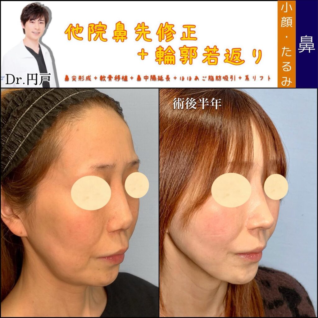他院の鼻先修正と輪郭形成の症例写真