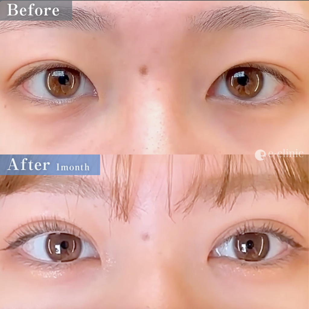 eclinicの二重症例(デザイン)
二重埋没法 クイックループダブル4点裏留め(名医の島田医師が執刀)