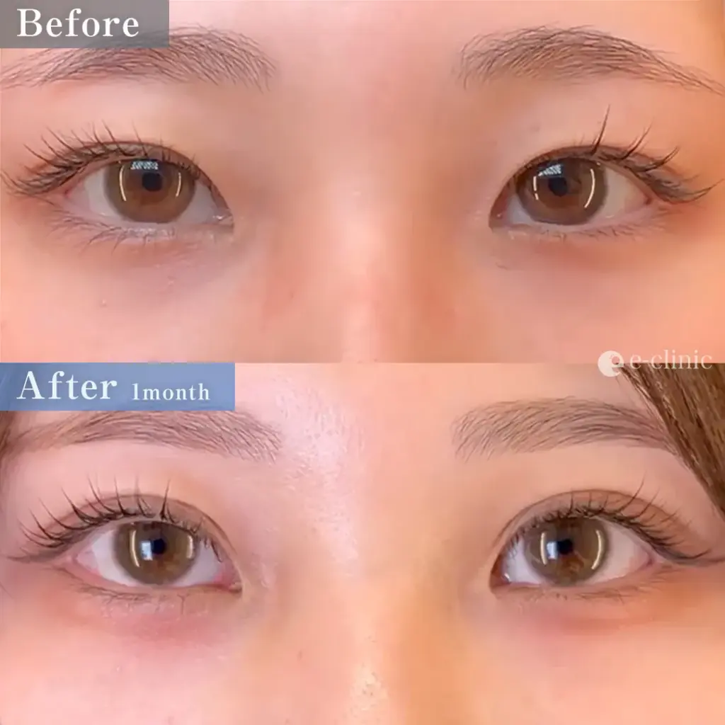 eclinicの二重症例(デザイン)
二重埋没法 クイックループダブル4点裏留め(名医の島田医師が執刀)