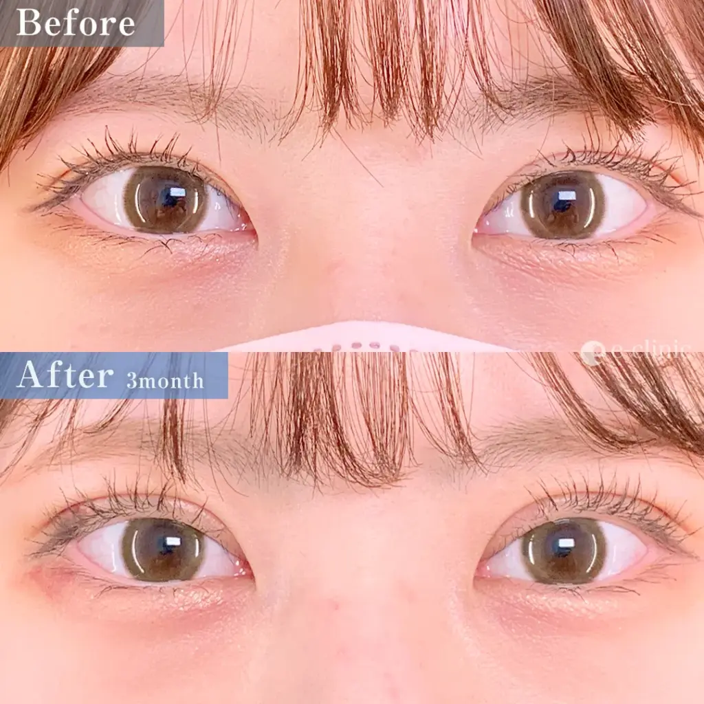 eclinicの二重症例(デザイン)
全切開二重術(名医の張田医師が執刀)