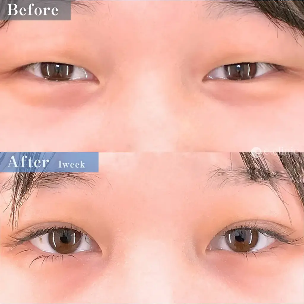 eclinicの二重症例(デザイン)
二重埋没法 特殊6裏留め(名医の坂本医師が執刀)