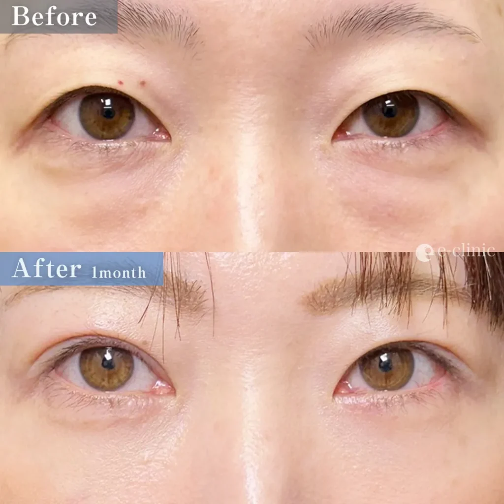 クマ取り_裏ハムラ法＋二重整形_自然癒着法（劉奕陽）（45）