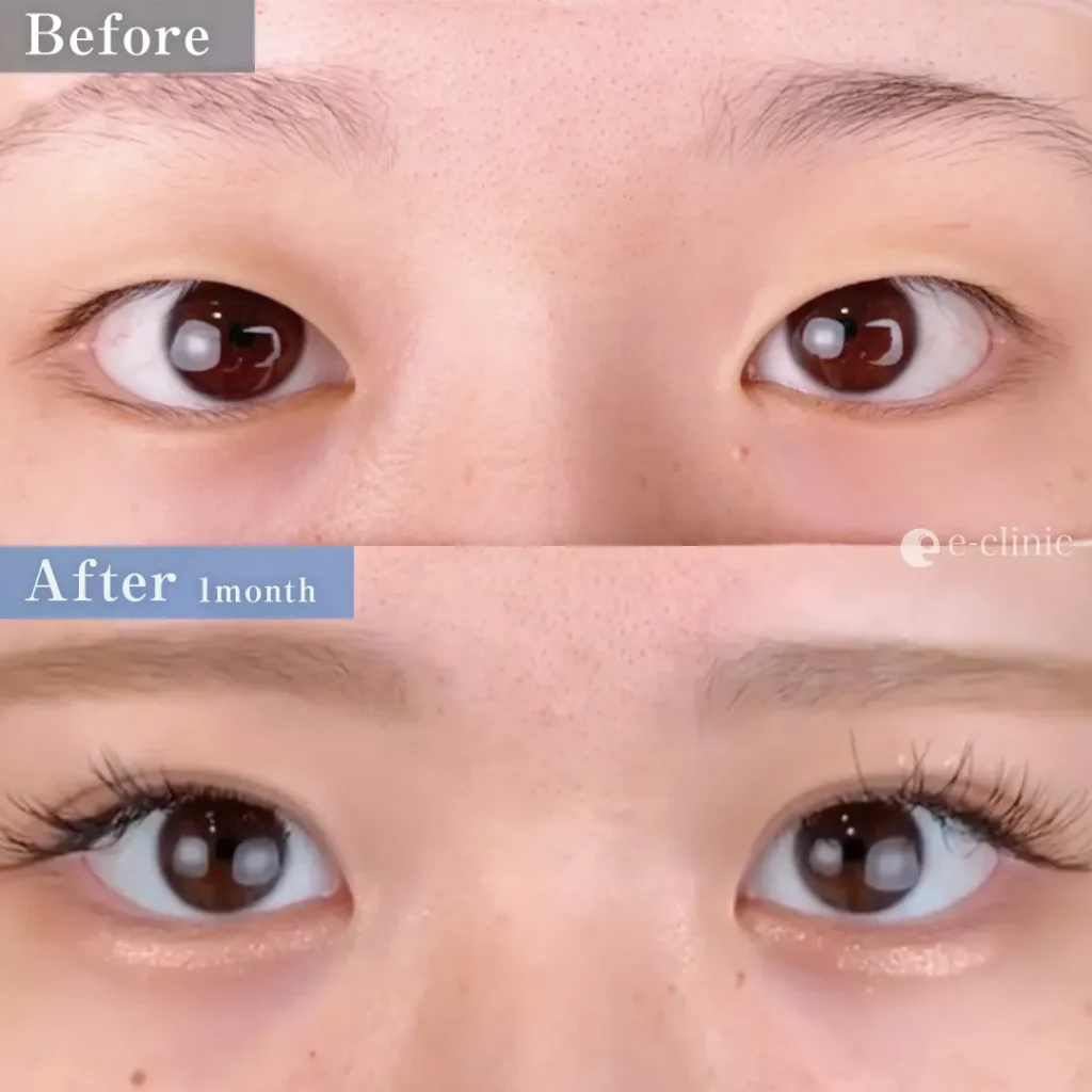 二重整形_埋没法 自然癒着法（劉奕陽）（46）