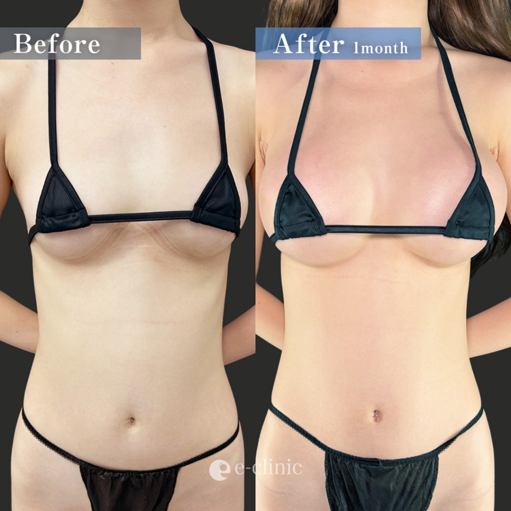 豊胸_ハイブリッド豊胸（田中里佳）（36）