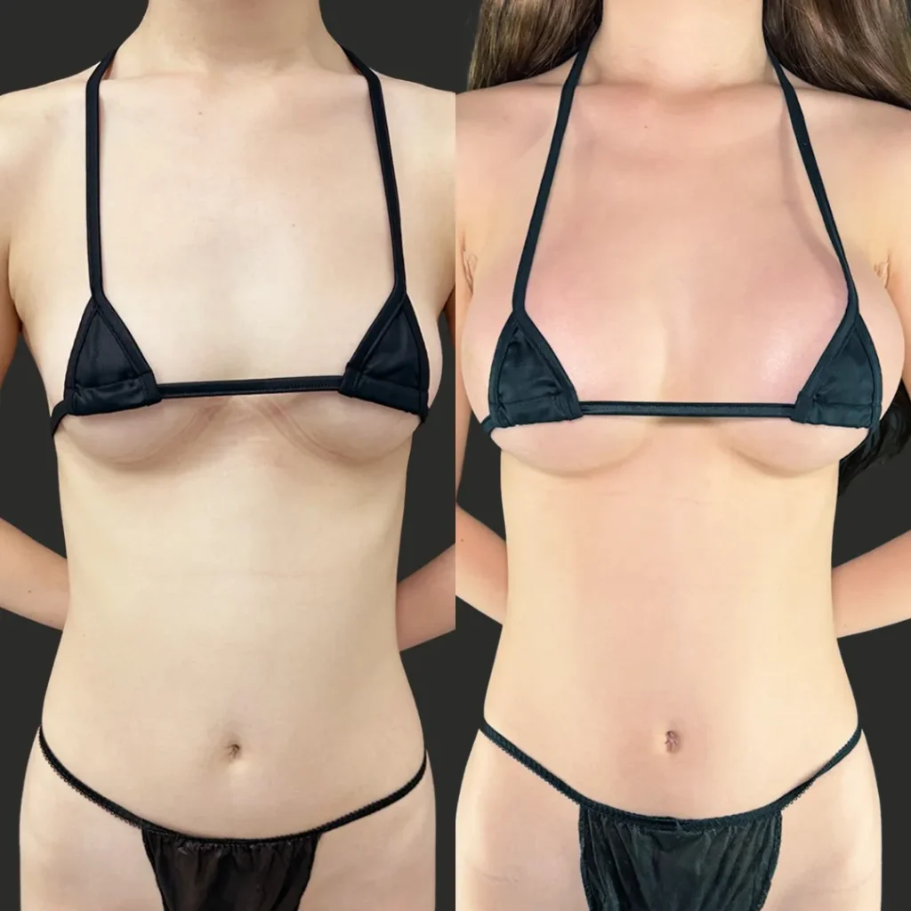 豊胸_ハイブリッド豊胸（田中里佳）（36）