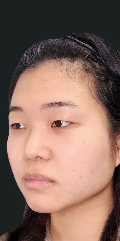 目フル＋鼻フル＋輪郭整形_（目頭、下瞼拡大、目尻靱帯移動、眼瞼下垂、全切開）＋（小鼻縮小、鼻尖形成＋軟骨移植＋鼻中隔延長＋オステオポール除去）＋（頬顎脂肪吸引）＋糸リフトの術前（名医の円戸望医師が執刀）（174）