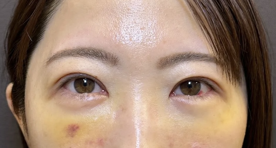 クマ取り_裏ハムラ法+二重整形_自然癒着法術後1週間(名医の劉奕陽医師が執刀)(45)