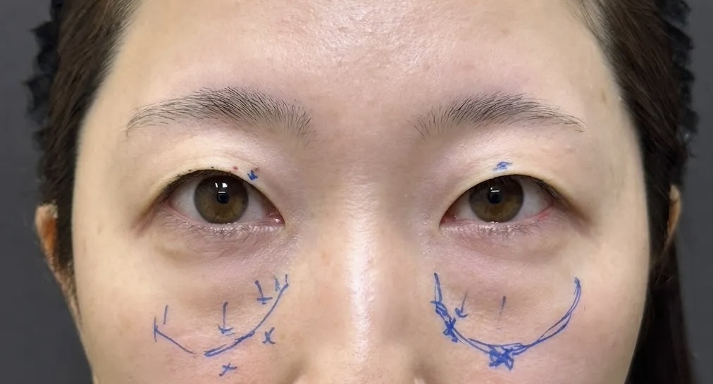 クマ取り_裏ハムラ法+二重整形_自然癒着法術前デザイン(名医の劉奕陽医師が執刀)(45)