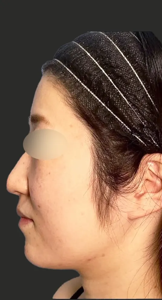 脂肪注入+脂肪吸引+糸リフト+鼻整形_(額・こめかみ・頬上部)+(顎下・頬下部)+糸16本+鼻中隔延長+鼻尖形成の術前(名医の円戸望医師が執刀)(108)